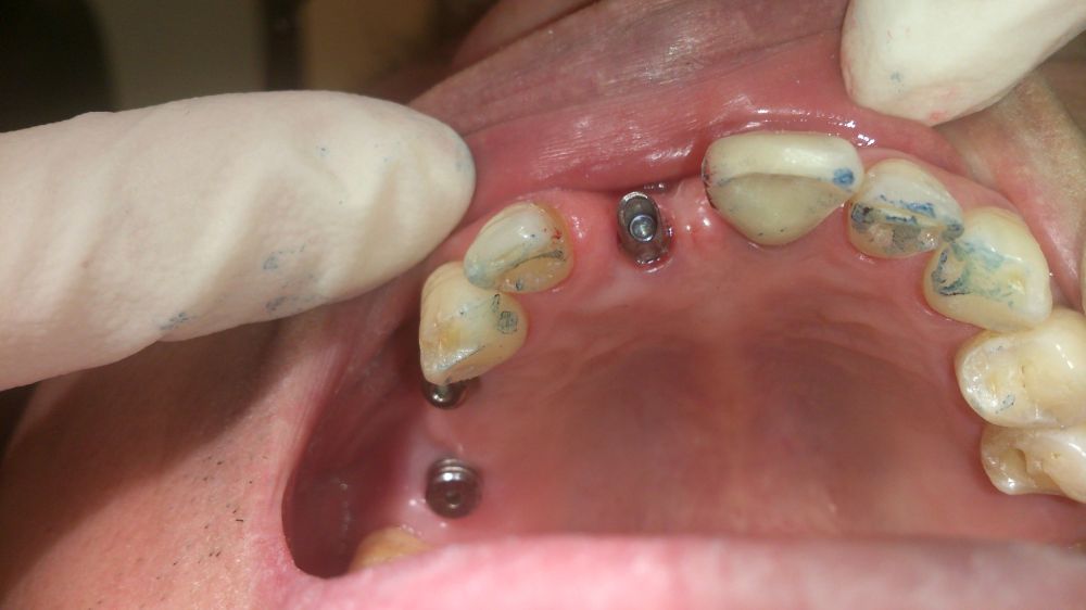 Dentures 1