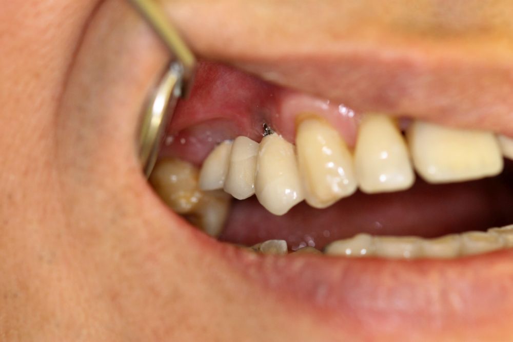 Dentures 3