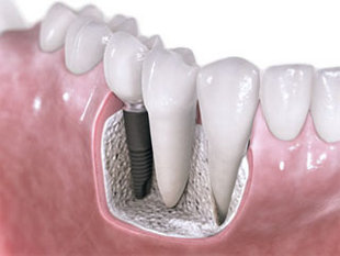 dental-bone-graft