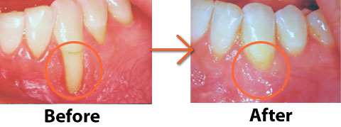 Image of Gum Grafting