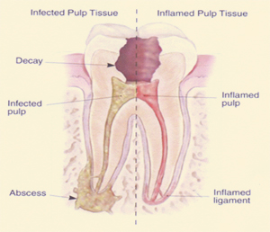 rootcanal_image